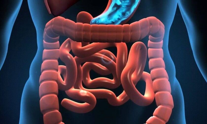 Νόσος Crohn και διατροφή: Τι να τρώτε, τι να αποφύγετε