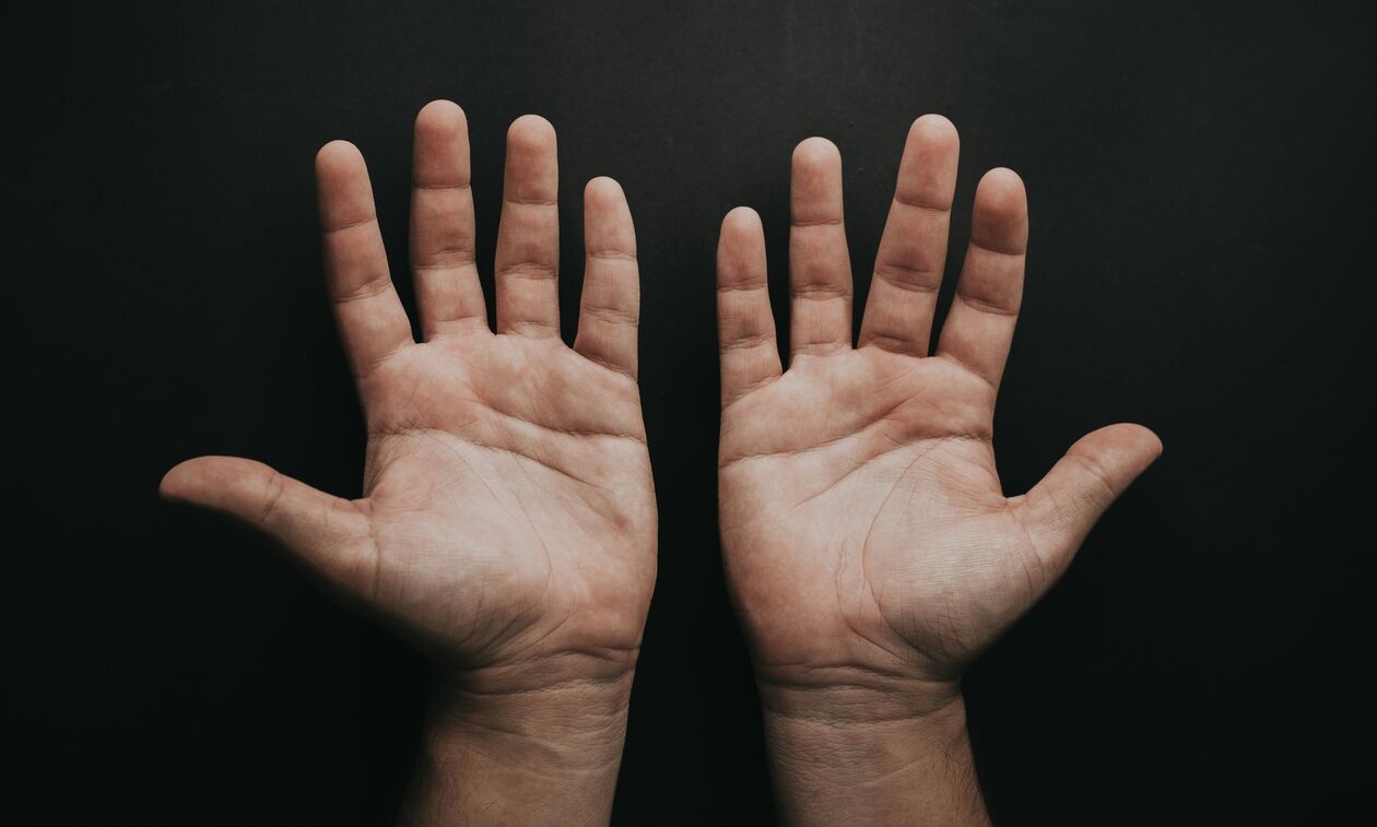 «Σκασμένα» χέρια: Πώς μπορούμε να τα βοηθήσουμε